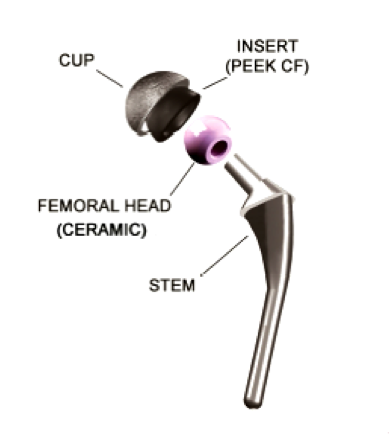 Schema della protesi testa femorale in materiale ceramico