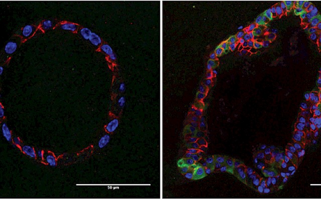 Cell changes drive breast cancer relapse