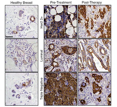 In tissues from patients, the scientists found that residual cells (right) have the same chemical hallmarks (dark brown) in different types of breast cancer (top, middle and bottom). IMAGE: Jechlinger/EMBL