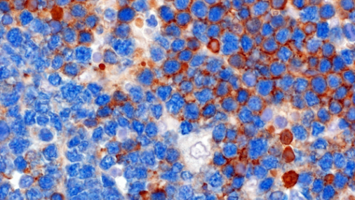 Linfomi: ricerca italiana svela la loro complessità e raccomanda l’uso di terapie combinate