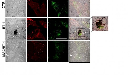 TUMORE OVARICO: DEFINITA INTERAZIONE TRE PROTEINE, INSIEME PROMUOVONO METASTASI