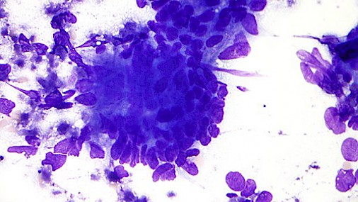 Le cellule tumorali vanno in letargo per evitare la chemioterapia?