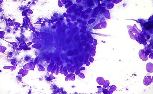 Colorectal adenocarcinoma cytology intermed mag. Credirs: Nephron, CC BY-SA 3.0, via Wikimedia Commons.